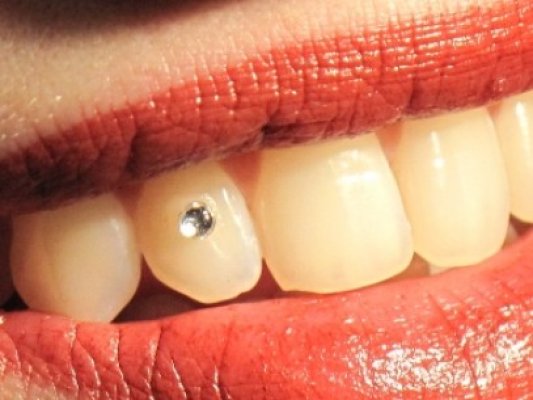 Bijuteriile dentare din zirconiu au trecere la constănţence